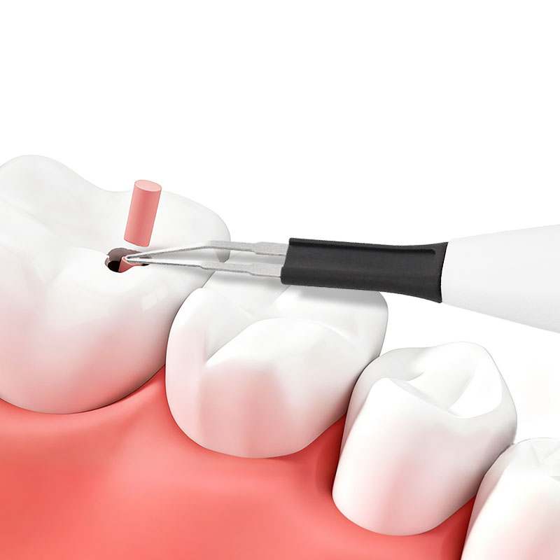 Wireless Gutta Percha Cutter – Rechargeable, Rapid Heating, Endodontic Obturation, 4 Tips - Image 3